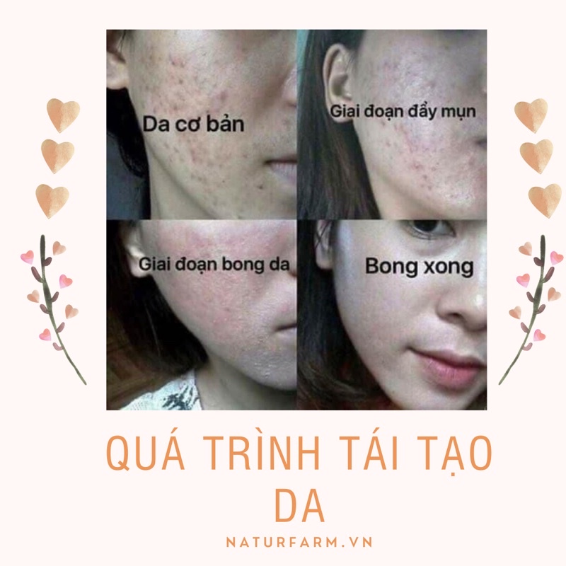 Thảo dược tái tạo da cải thiện mụn, nám, tàn nhang, sẹo rỗ naturfarm