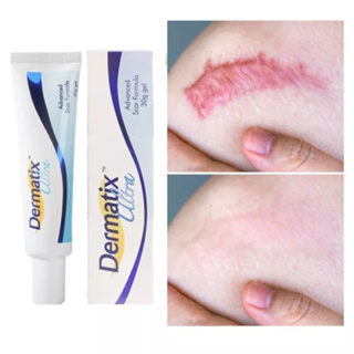 Gel Dermatix Ultra hỗ trợ dưỡng da giúp da lành sẹo 7g và 15g